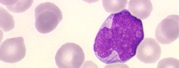 Figure 2 Blaste leucemique de LAM